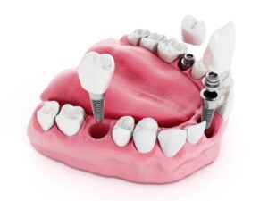 Cost Of Dental implants in Antalya