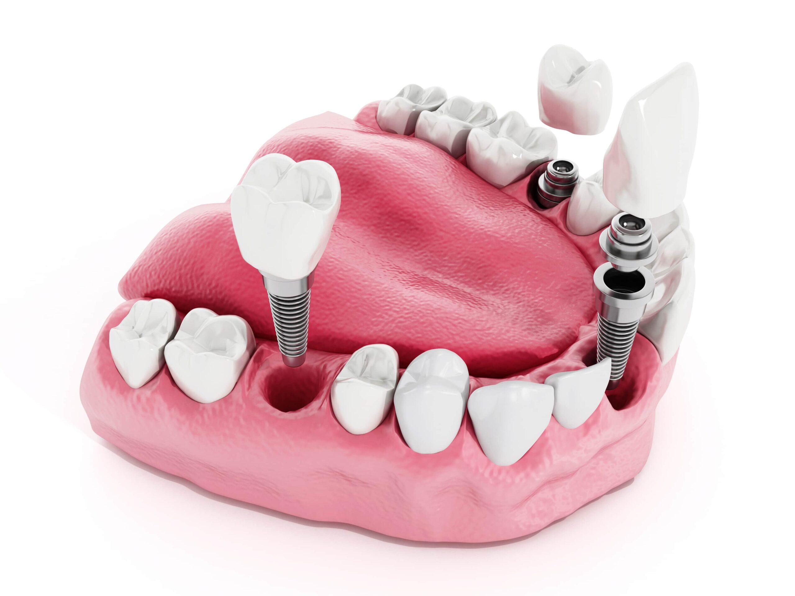 Cost Of Dental implants in Antalya